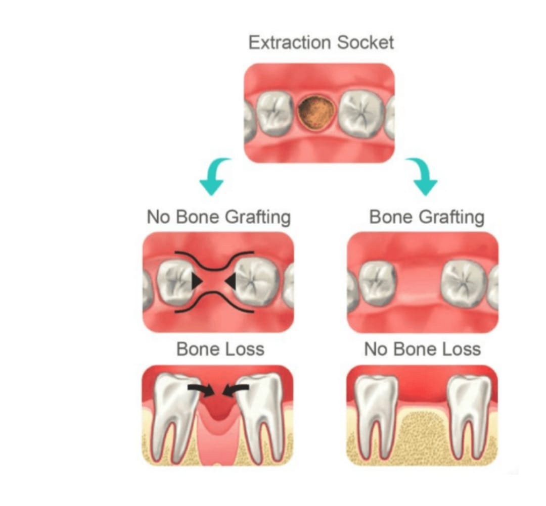 bone-grafting